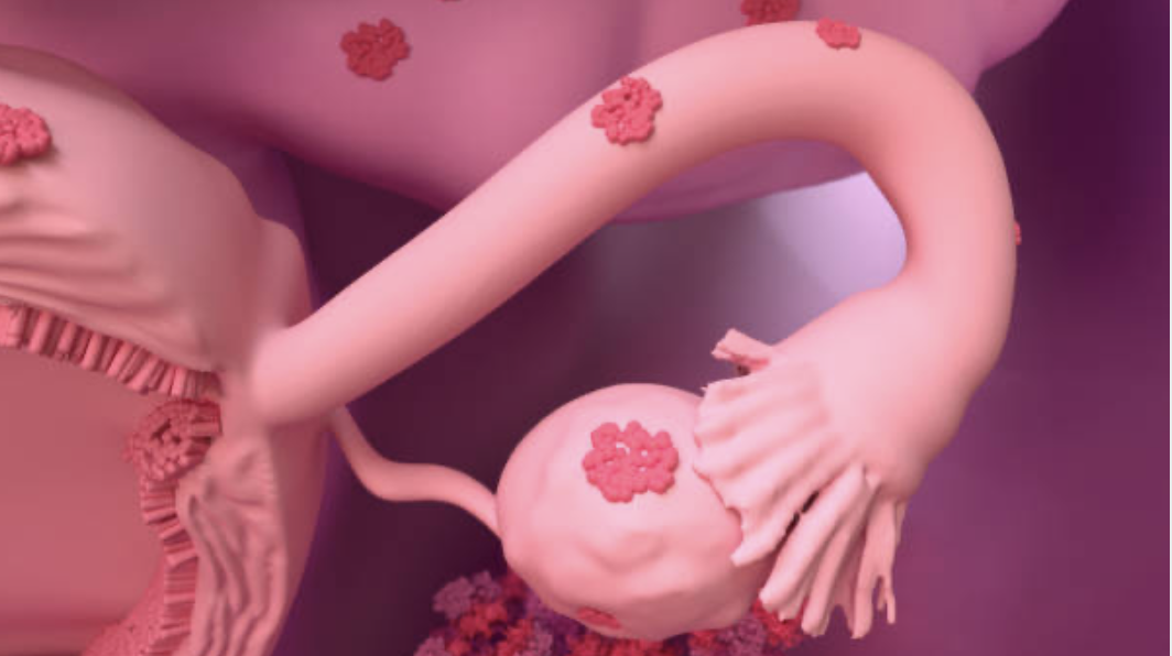 ENDOMÉTRIOSE ET OSTÉOPATHIE